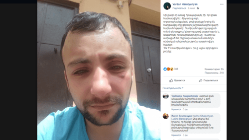 Beaten Vardan Arutyunyan. Screenshot of his Facebook post dated June 3: https://www.facebook.com/photo.php?fbid=2453172568055999&set=a.618587571514517&type=3&theater 